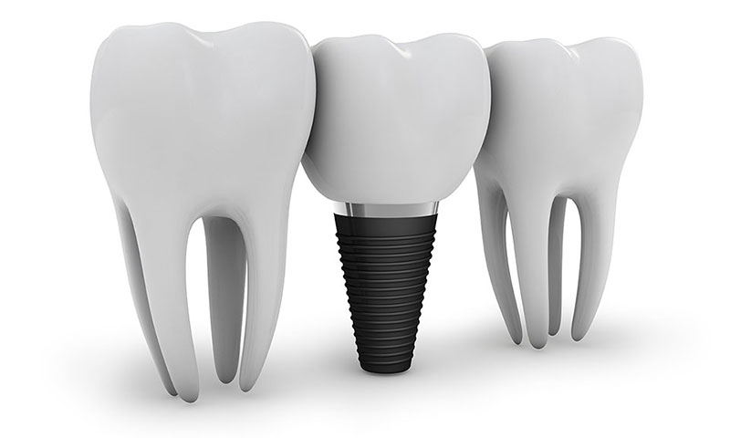 dental implants union city