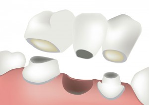 dental bridges