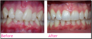 invisalign union city