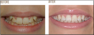 invisalign teen