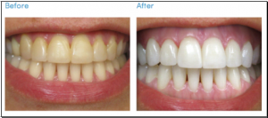 teeth whitening in union city